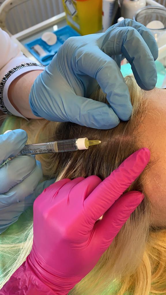 hair filler mesotherapy